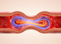 Bernstein polynomials crack the equations of nanofluid blood flow in stenosed arteries