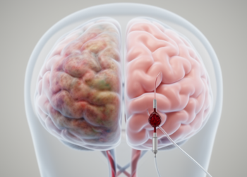 Thrombectomy improves functional outcome in large core stroke partly by preventing severe cerebral edema: a real-world mediation analysis