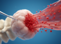 Liquid Biopsy Catches Cancer Cells Slipping Into Blood During Cervical Cancer Surgery