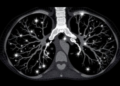 Contrast-Enhanced Ultrasound Guides Lung Cancer Biopsies When Bronchoscopy Fails