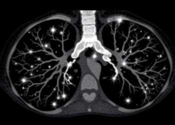 Contrast-Enhanced Ultrasound Guides Lung Cancer Biopsies When Bronchoscopy Fails