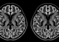 Post-mortem MRI reveals how fetal brains first begin to form the folds of polymicrogyria