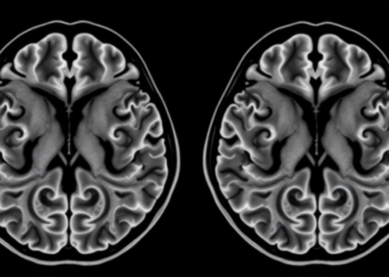 Post-mortem MRI reveals how fetal brains first begin to form the folds of polymicrogyria