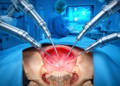 Robotic Surgery Reaches the Abdomen's Toughest Corner to Fix Rare Hernias