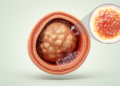Hidden cancers inside ovarian teratomas: solid clues that flag rare transformation