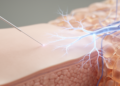 Acupuncture Shows Measurable Effects on Nerve Regeneration, but the Evidence Is Not Yet Solid