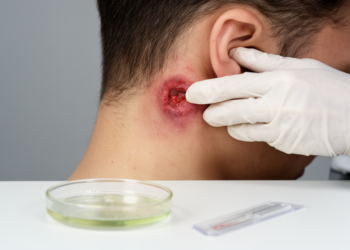 Rare Ear-Area Abscess Traced to Obscure Anaerobic Bacterium in First Documented Case
