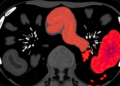 AI Learns to Spot Bile Duct Cancer on Multiphase CT Scans