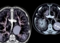 AI Reads Fetal MRI Lungs in Seconds, Transforming Prenatal Risk Assessment