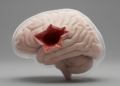 The Shape of a Postoperative Brain Lesion May Predict Neurological Decline After Glioma Surgery