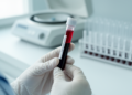 Lymphopenia emerges as earliest and most frequent blood toxicity in cervical cancer chemoradiation study