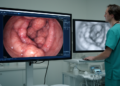 Diffusion-Inspired AI Model Reads Ulcerative Colitis Severity from Endoscopy Images