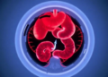 CZT Camera SPECT/CT Finds Hidden Gastrointestinal Bleeding That CT Misses
