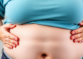Obesity, Skin Barriers and Swelling Drive Cellulitis Risk, Large Study Finds