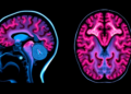 Brain imaging in dystrophinopathies